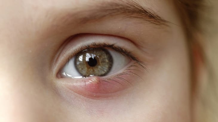 gerstenkorn am auge 2026: ursachen, symptome, behandlung und schnelle hilfe richtig erklärt