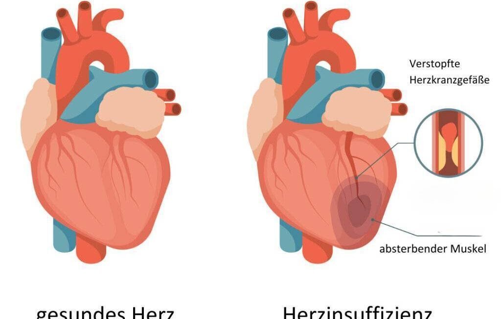 herzinsuffizienz was ist das: Ursachen, Symptome und Behandlung