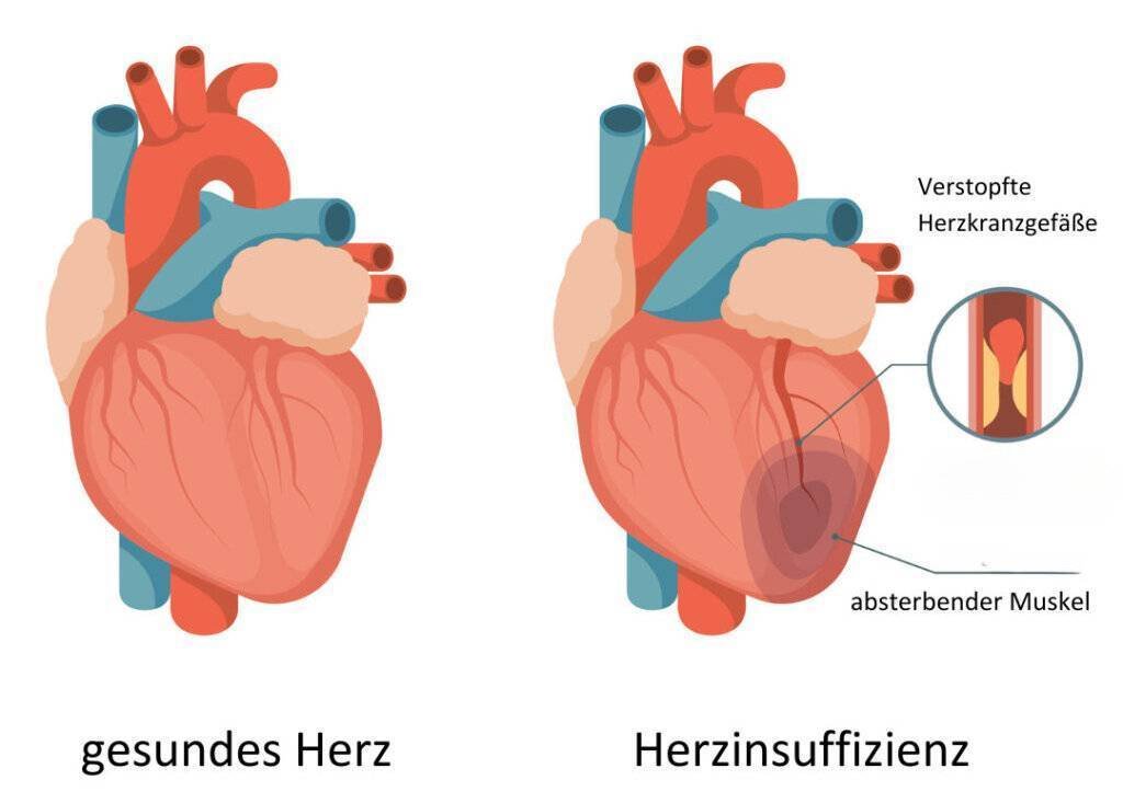 herzinsuffizienz was ist das