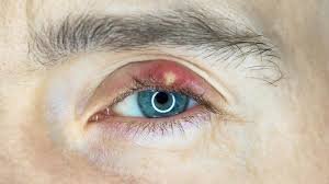 gerstenkorn am auge